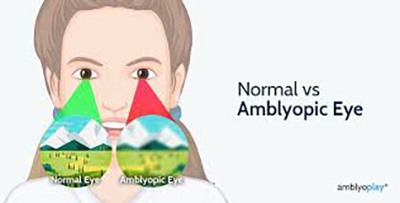 Amblyopic Eye
